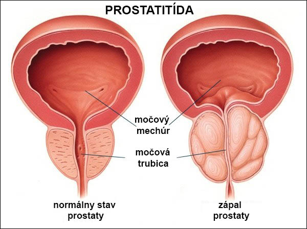 Simptomele debutului prostatitei