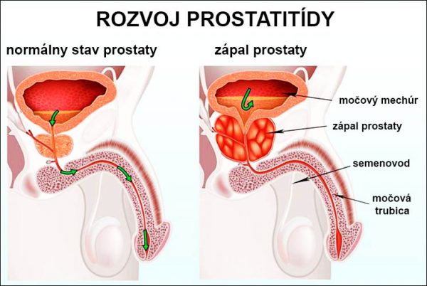 Probleme cu prostata: cauze, remedii naturale si dieta | masinideepocanunti.ro